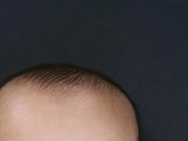 Differences, Benefits, and Sources: Folate versus Folic Acid